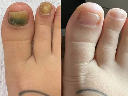 تخلّص من فطريات الأظافر في 3 أسابيع فقط