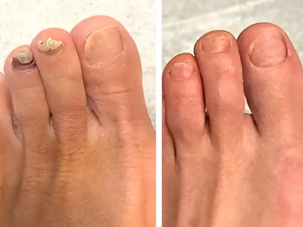 تخلّص من فطريات الأظافر في 3 أسابيع فقط