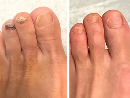 تخلّص من فطريات الأظافر في 3 أسابيع فقط