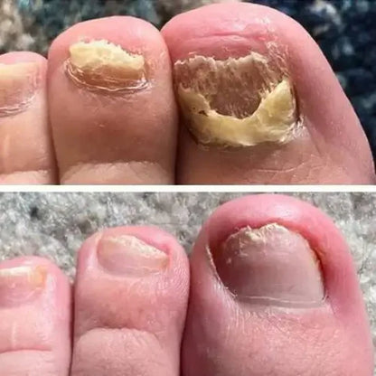 تخلّص من فطريات الأظافر في 3 أسابيع فقط