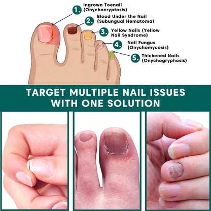 تخلّص من فطريات الأظافر في 3 أسابيع فقط